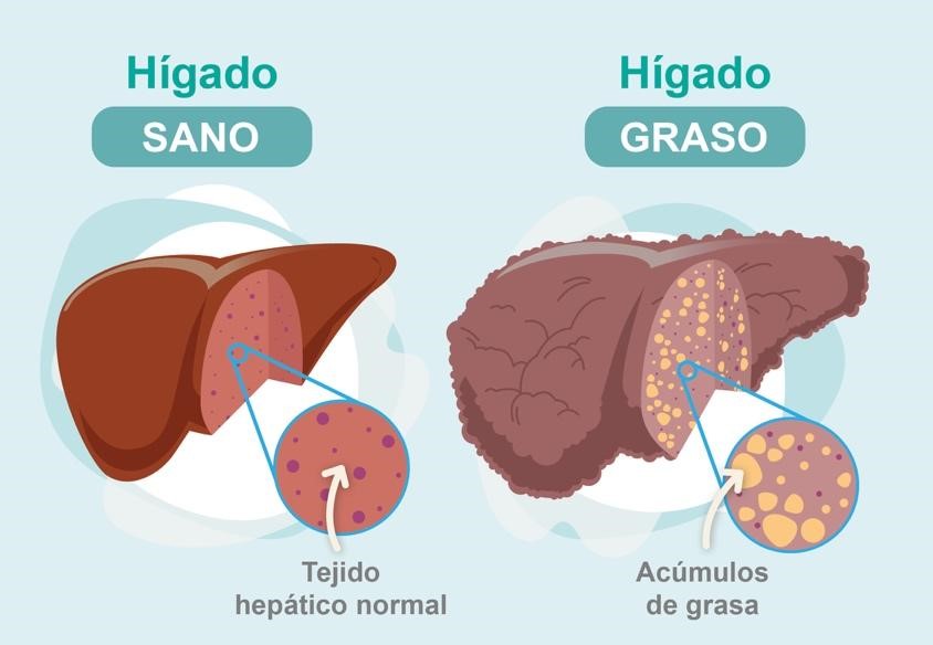 Si tiene hígado graso, haga esto!